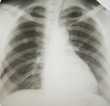 Here you will find an x-ray taken of an individual with mesothelioma cancer.
