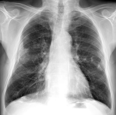 Asbestosis Xray Picture  Mesothelioma Treatment Centers.org