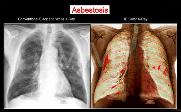 asbestosis-symptoms
