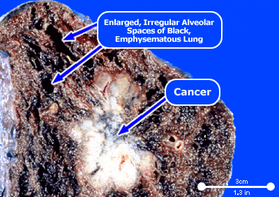 mesothelioma-lung-cancer