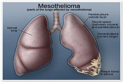 mesothelioma-lung400