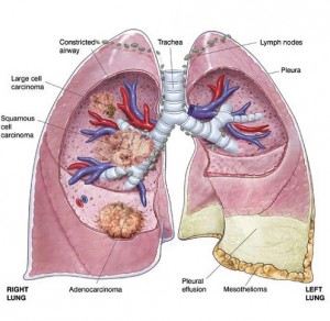 what-is-mesothelioma-lung-cancer